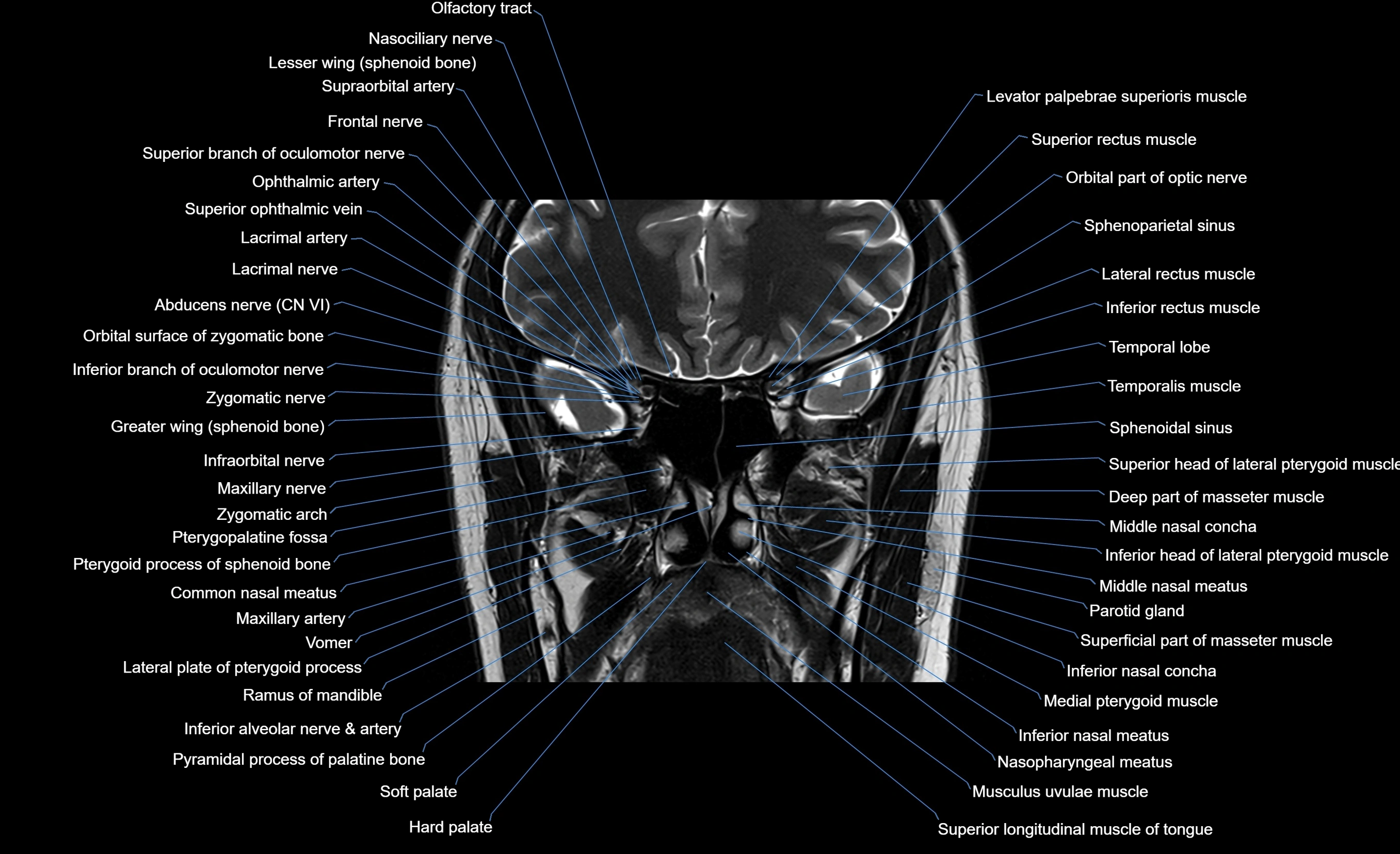 MRI face & paranasal sinuses(PNS) labelled  coronal  cross sectional anatomy 3T radiology  image-img-00001-00029.webp